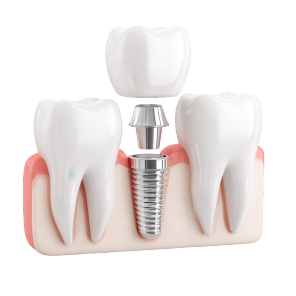 Dental Implants in Ealing at Stunning Smile Clinic, Ealing